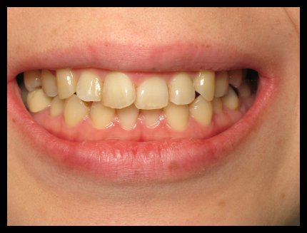 6 Month Braces Before
