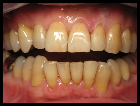 Tooth Colored Fillings After