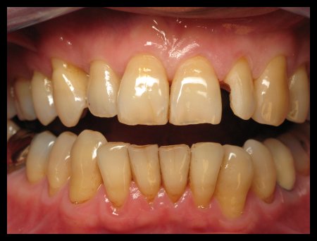 Tooth Colored Fillings Before
