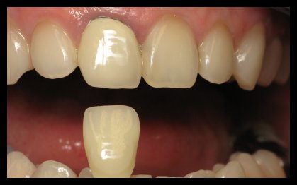 Dental Crowns & Bridges Before