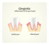 Different types of gum periodontal disease