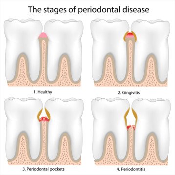 Symptoms of Periodontal Disease