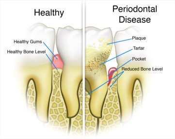 How is obesity linked to gum inflammation and jaw bone loss? - Complete  Smile Dental